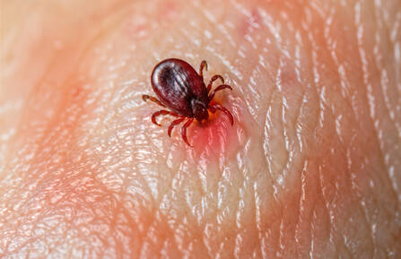 A tick on a person's skin that shows a "bull's-eye" appearance