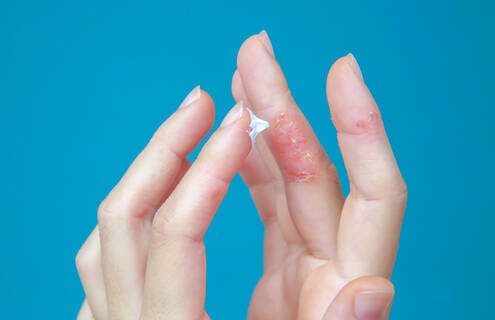 Two hands, one with red patches on the fingers, the other applying cream to those fingers