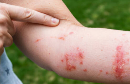 An arm with heat rash